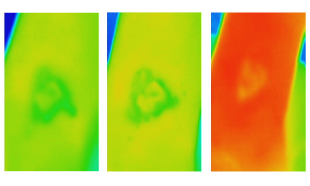  Thermal images of a venous leg ulcer that ultimately failed to heal. Image Credit: RMIT University