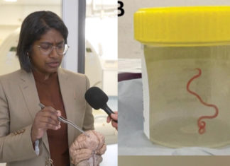 Indian Australian doctor removes 3-inch long-live parasitic worm; Image Source Screen Shots @BBC Video
