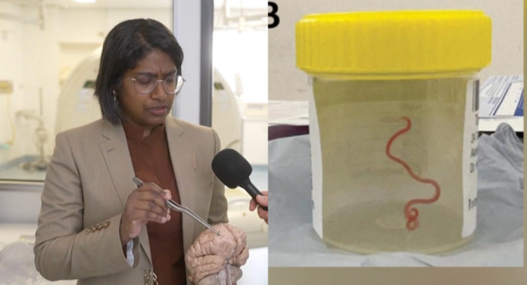 Indian Australian doctor removes 3-inch long-live parasitic worm from woman’s brain