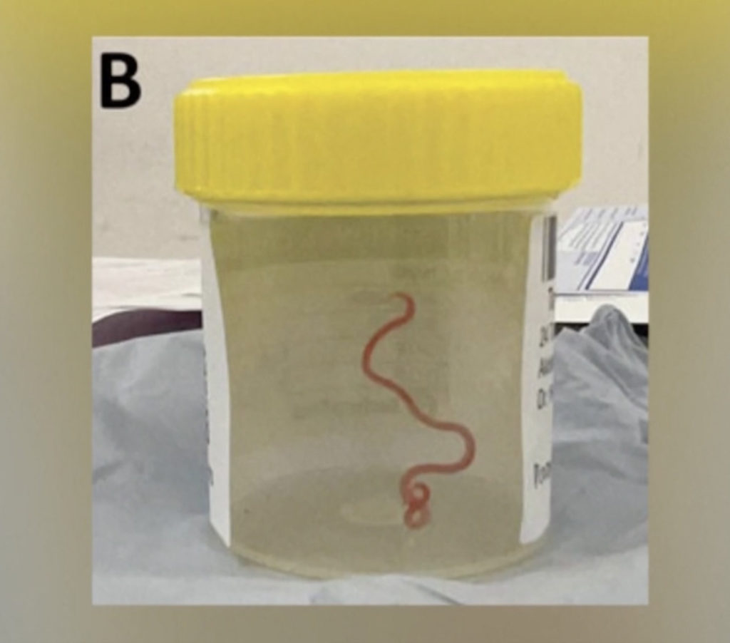 Indian Australian doctor removes 3-inch long-live parasitic worm; Image Source Screen Shots @BBC Video