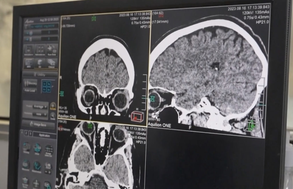 Indian Australian doctor removes 3-inch long-live parasitic worm; Image Source Screen Shots @BBC Video