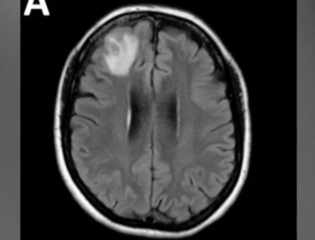 Indian Australian doctor removes 3-inch long-live parasitic worm; Image Source Screen Shots @BBC Video