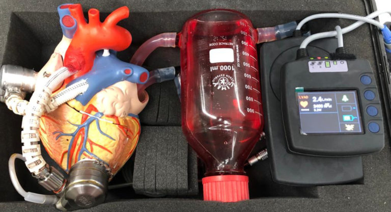 Aussie company with Indian investors creating device to assist with end stage heart failure