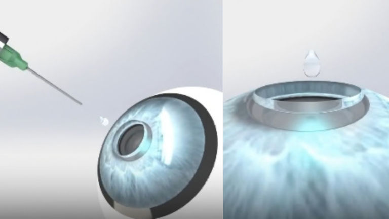 Indian innovation aims to help the blind see again with a “liquid cornea”