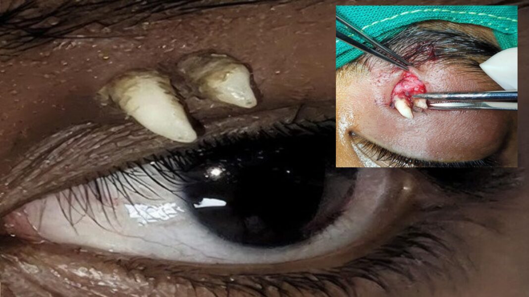 Image: Doctors successfully performed to remove the tooth (Source: aaojournal)