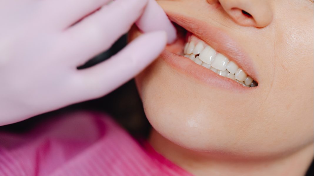 Representative image: Mouth ulcers (Source: CANVA)